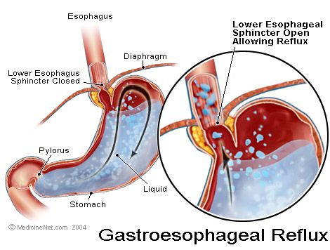 gastrooisofagiki palindromisi